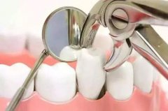 有關牙齒矯正的五大疑問 瞭解它盡早走出誤區