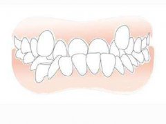幾種常見的錯頜畸形