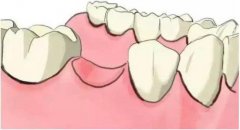 拔牙後多久可以鑲牙