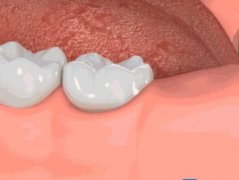 拔牙術後的感染怎麼辦？