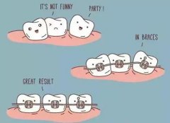 箍牙會不會傷害到牙齒？
