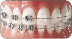 牙齒矯正一共有哪些方法？