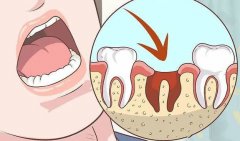 拔牙後化膿自己能好嗎？