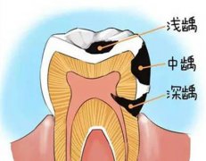 牙齒蛀牙痛可以拔牙嗎？