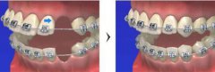 矯正拔牙會對身體造成傷害嗎？