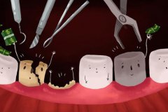 牙拔除術的適應征有哪些？