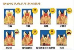 從淺齲到拔牙，你珍惜你的牙齒嗎？