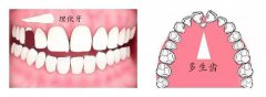 拔複雜難牙後患者須註意什麼？