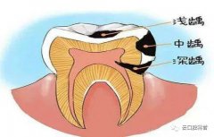 如何预防虫牙？
