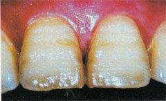 兒童牙齒保健之遺傳因素（上）