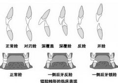 隱形矯正讓您展現自信笑容