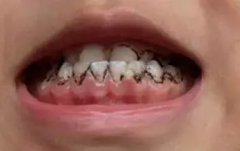 寶寶牙齒上的黑色素能去掉嗎？