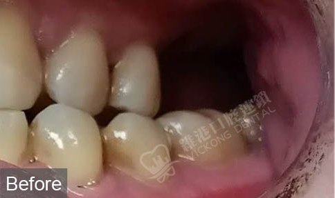 左上磨牙缺失