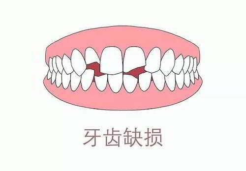 深圳牙齒缺損