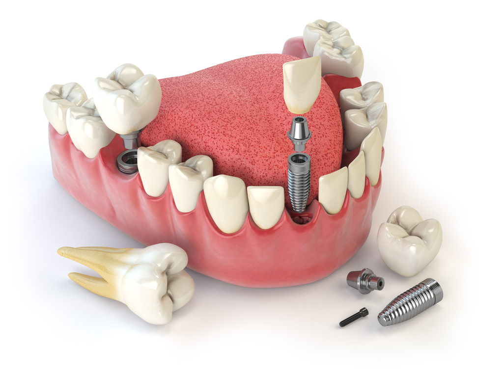 牙齒種植手術小常識