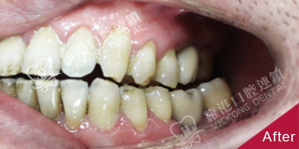 牙齒缺失,深圳種植修復