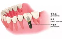 種植牙和鑲牙，到底哪個好？