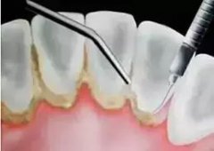 洗牙和牙周刮治的區別在哪裡？