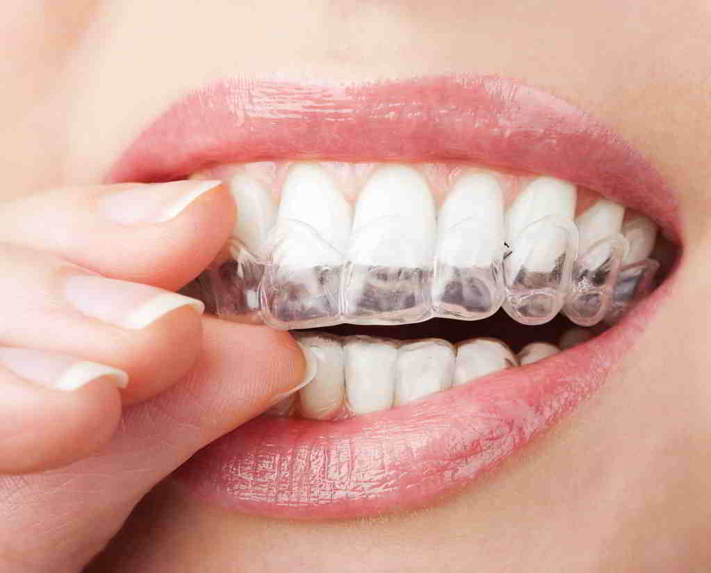 牙齒稀疏治療方法,牙齒稀疏方式