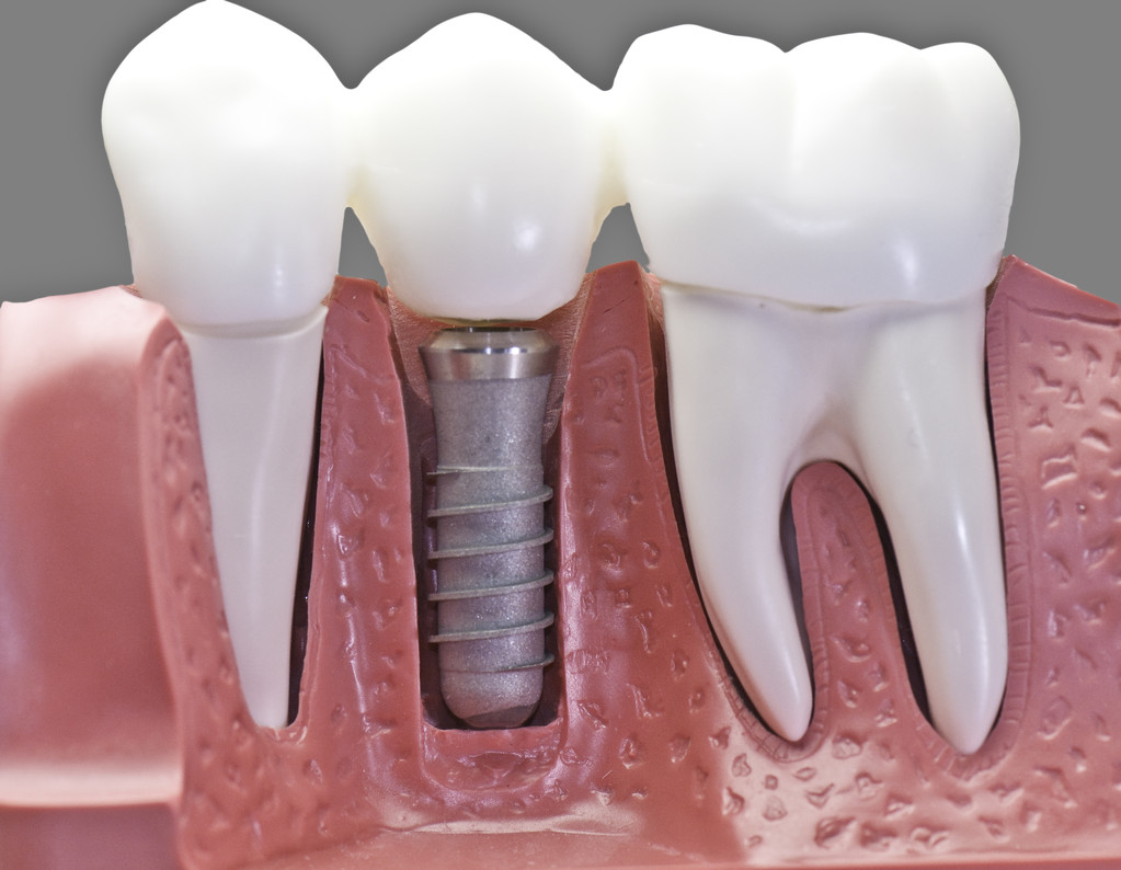 種植義齒的適應證有哪些？