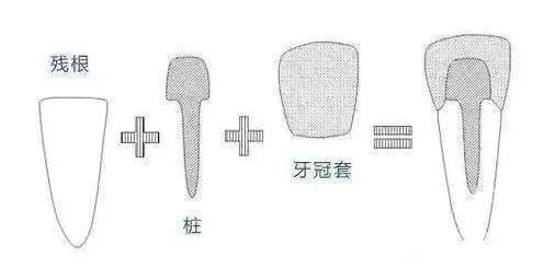 杜牙根後為什麼要戴牙冠