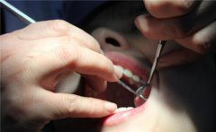 香港牙醫建議:補牙一定要趁早!什麼時候應該補牙